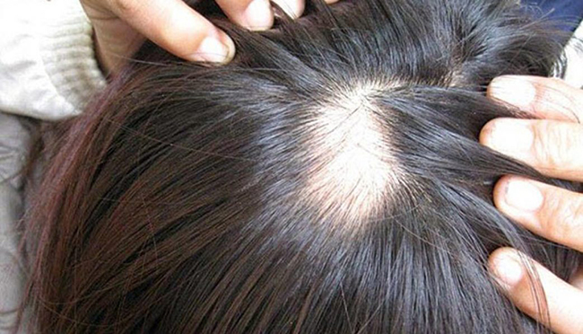 Rụng tóc hói đầu đầu xảy ra ở cả nam và nữ 