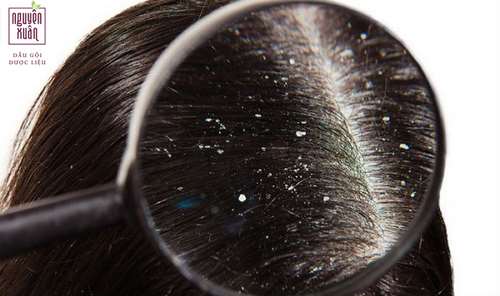 Chăm sóc tóc bị gàu thế nào để đạt hiệu quả