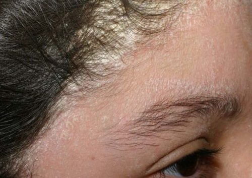 Nên sử dụng loại dầu gội nào để điều trị nấm da đầu lan xuống mặt?
