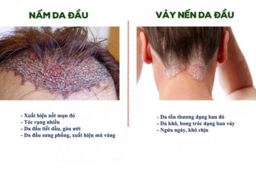 Các yếu tố nguy cơ nào làm tăng nguy cơ mắc vảy nến da đầu và nấm da đầu?
