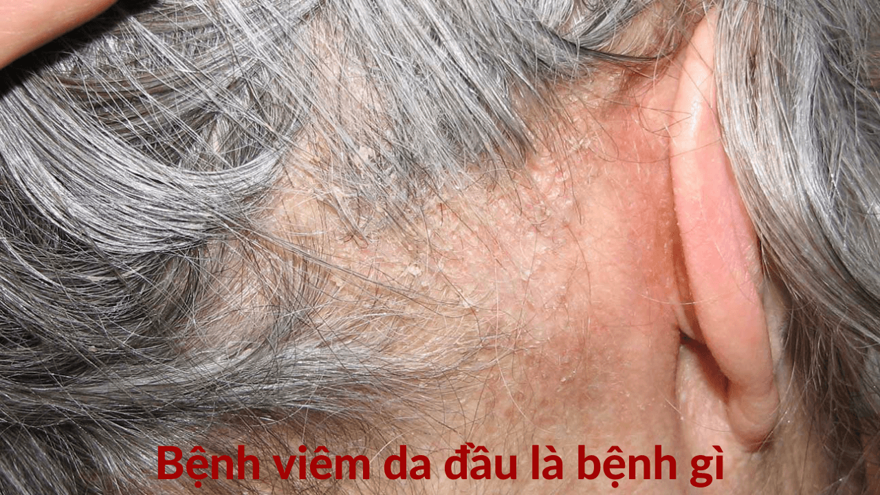 Bệnh viêm da đầu phổ biến ở mọi lứa tuổi