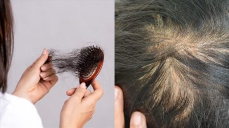 Bệnh gì gây rụng tóc nhiều?